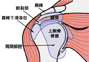 Rotator_cuff_tear_01